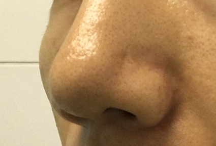 メンズTBCイチゴ鼻